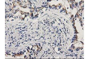 Immunohistochemical staining of paraffin-embedded Carcinoma of Human lung tissue using anti-PNMT mouse monoclonal antibody. (PNMT anticorps)
