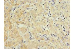 Immunohistochemistry of paraffin-embedded human liver cancer using ABIN7151102 at dilution of 1:100 (Pellino 3 anticorps  (AA 1-280))