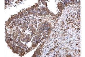 IHC-P Image LOXL2 antibody detects LOXL2 protein at cytosol on human ovarian carcinoma by immunohistochemical analysis. (LOXL2 anticorps)