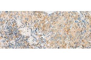 Immunohistochemistry of paraffin-embedded Human cervical cancer tissue using CNPY3 Polyclonal Antibody at dilution of 1:55(x200) (TNRC5 anticorps)