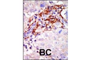 Formalin-fixed and paraffin-embedded human cancer tissue reacted with the primary antibody, which was peroxidase-conjugated to the secondary antibody, followed by AEC staining.