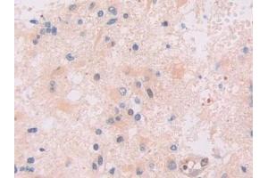 Detection of IFI16 in Human Glioma Tissue using Polyclonal Antibody to Interferon Gamma Inducible Protein 16 (IFI16)