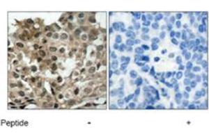 Immunohistochemical analysis of paraffin-embedded human breast carcinoma tissue using FOXO3 polyclonal antibody  .