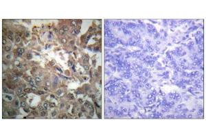 Immunohistochemistry analysis of paraffin-embedded human breast carcinoma tissue using XPA antibody. (XPA anticorps  (C-Term))