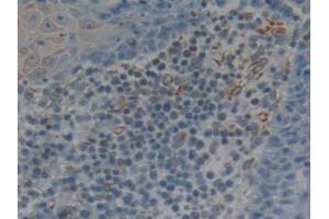 IHC-P analysis of Human Skin Cancer Tissue, with DAB staining. (CD25 anticorps  (AA 22-213))