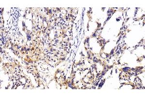 Detection of RNASE3 in Human Ovarian cancer Tissue using Polyclonal Antibody to Ribonuclease A3 (RNASE3)