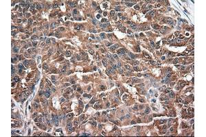 Immunohistochemical staining of paraffin-embedded Adenocarcinoma of colon using anti-NTF3 (ABIN2452548) mouse monoclonal antibody. (Neurotrophin 3 anticorps  (AA 139-257))