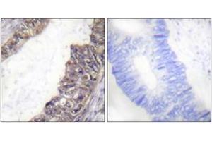 Immunohistochemistry analysis of paraffin-embedded human colon carcinoma, using GIRK1/KIR3. (KCNJ3 anticorps  (pSer185))