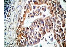 Human stomach cancer tissue was stained by rabbit Anti-Spexin prepro (73-116)  (H) Antiserum (Spexin anticorps  (Preproprotein))