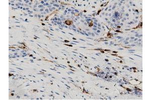 Immunohistochemical staining of paraffin-embedded Carcinoma of Human kidney tissue using anti-ARHGAP25 mouse monoclonal antibody. (ARHGAP25 anticorps)