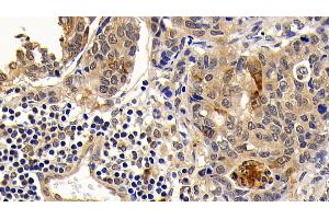 Detection of Bcl2L in Human Lymphoma Tissue using Monoclonal Antibody to B-Cell CLL/Lymphoma 2 Like Protein (Bcl2L)