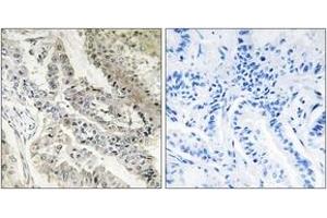 Immunohistochemistry analysis of paraffin-embedded human lung carcinoma tissue, using CRBP III Antibody. (Retinol Binding Protein 5 anticorps  (AA 10-59))