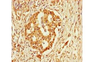 Immunohistochemistry of paraffin-embedded human pancreatic cancer using ABIN7152927 at dilution of 1:100 (FBLN7 anticorps  (AA 25-393))