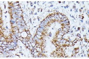 Immunohistochemistry of paraffin-embedded Human colon carcinoma using PPP2CB Polyclonal Antibody at dilution of 1:100 (40x lens).