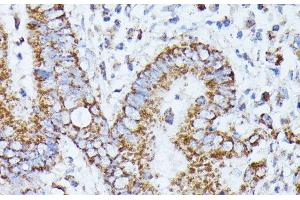 Immunohistochemistry of paraffin-embedded Human colon carcinoma using PPP2CB Polyclonal Antibody at dilution of 1:100 (40x lens). (PPP2CB anticorps)