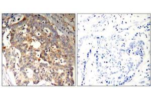 Immunohistochemical analysis of paraffin-embedded human breast carcinoma tissue using SAPK/JNK (Ab-183) Antibody (E021241). (SAPK, JNK anticorps)