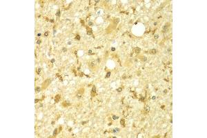 Immunohistochemistry of paraffin-embedded human brain cancer using SPAG16 antibody at dilution of 1:100 (x400 lens). (SPAG16 anticorps)