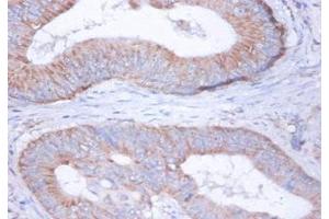 Immunohistochemistry of paraffin-embedded human colon cancer using ABIN7149114 at dilution of 1:100 (UQCRFS1 anticorps  (AA 79-274))