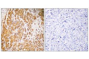 Immunohistochemistry analysis of paraffin-embedded human breast carcinoma tissue, using ZSCAN22 antibody. (ZSCAN22 anticorps  (Internal Region))