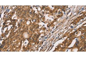 Immunohistochemistry of paraffin-embedded Human gasrtic cancer tissue using DICER1 Polyclonal Antibody at dilution 1:40 (DICER1 anticorps)