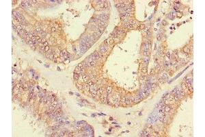 Immunohistochemistry of paraffin-embedded human endometrial cancer using ABIN7151005 at dilution of 1:100 (CHFR anticorps  (AA 141-422))