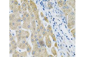 Immunohistochemistry of paraffin-embedded Human liver cancer using ALG2 Polyclonal Antibody at dilution of 1:100 (40x lens). (ALG2 anticorps)