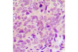 Immunohistochemical analysis of PTP1B staining in human breast cancer formalin fixed paraffin embedded tissue section.