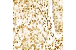Immunohistochemistry of paraffin-embedded human gastric cancer using DKC1 Antibody (ABIN5970956) at dilution of 1/100 (40x lens). (DKC1 anticorps)