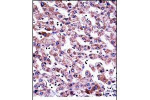 GDI2 Antibody (Center) ((ABIN657709 and ABIN2846700))immunohistochemistry analysis in formalin fixed and paraffin embedded human liver tissue followed by peroxidase conjugation of the secondary antibody and DAB staining. (GDI2 anticorps  (AA 135-164))