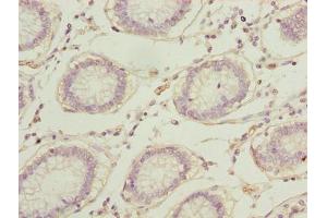 Immunohistochemistry of paraffin-embedded human colon cancer using ABIN7167697 at dilution of 1:100 (RPA2 anticorps  (AA 1-267))