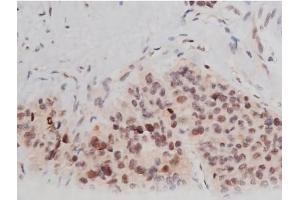 ABIN6267361 at 1/200 staining Human liver cancer tissue sections by IHC-P. (MAPT anticorps  (pThr181))