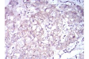 Immunohistochemical analysis of paraffin-embedded breast cancer tissues using NTRK2 mouse mAb with DAB staining.
