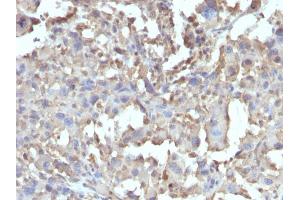 Formalin-fixed, paraffin-embedded human Histiocytoma stained with TNF alpha Rabbit Recombinant Monoclonal Antibody (TNF/1500R). (Recombinant TNF alpha anticorps)