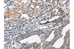 The image on the left is immunohistochemistry of paraffin-embedded Human gastric cancer tissue using ABIN7128332(AKR1D1 Antibody) at dilution 1/35, on the right is treated with fusion protein. (AKR1D1 anticorps)