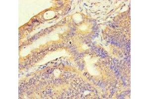 Immunohistochemistry of paraffin-embedded human colon cancer using ABIN7171536 at dilution of 1:100 (TAS2R13 anticorps  (AA 150-184))