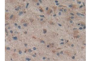 Detection of HMGCS in Human Glioma Tissue using Polyclonal Antibody to Hydroxymethylglutaryl Coenzyme A Synthase (HMGCS) (HMGCS1 anticorps  (AA 293-467))
