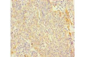 Immunohistochemistry of paraffin-embedded human cervical cancer using ABIN7166699 at dilution of 1:100 (PAGE2B anticorps  (AA 1-111))