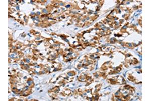The image on the left is immunohistochemistry of paraffin-embedded Human thyroid cancer tissue using ABIN7129698(HINT2 Antibody) at dilution 1/40, on the right is treated with fusion protein. (HINT2 anticorps)