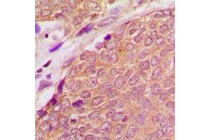 Immunohistochemical analysis of ASC staining in human breast cancer formalin fixed paraffin embedded tissue section.