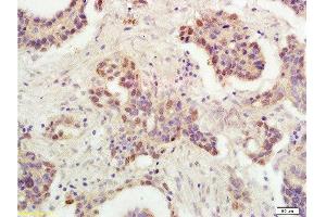 Formalin-fixed and paraffin embedded human ovarian carcinoma labeled with Rabbit Anti-P53 protein(wt-p53) Polyclonal Antibody , Unconjugated 1:300 followed by conjugation to the secondary antibody and DAB staining (p53 anticorps  (AA 251-310))