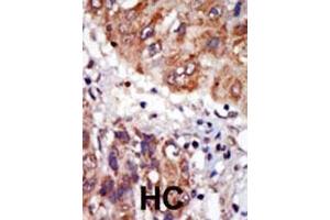 Formalin-fixed and paraffin-embedded human cancer tissue reacted with the primary antibody, which was peroxidase-conjugated to the secondary antibody, followed by DAB staining.