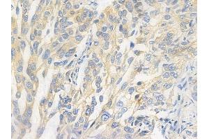 ABIN6265789 and ABIN6278090 at 1/100 staining human lung squamous cell carcinoma by IHC-P. (TUBA1B anticorps  (N-Term))