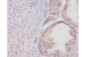 Immunohistochemistry of paraffin-embedded human colon cancer using ABIN7178837 at dilution of 1:20 (COL1A1 anticorps  (AA 955-1207))
