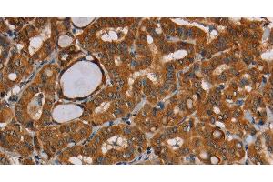 Immunohistochemistry of paraffin-embedded Human thyroid cancer tissue using CENPU Polyclonal Antibody at dilution 1:30 (MLF1IP anticorps)