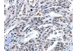 The image on the left is immunohistochemistry of paraffin-embedded Human ovarian cancer tissue using ABIN7191321(LRP5 Antibody) at dilution 1/55, on the right is treated with synthetic peptide. (LRP5 anticorps)