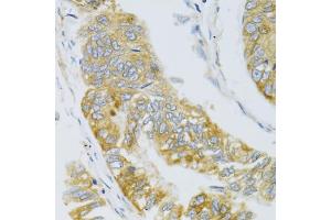 Immunohistochemistry of paraffin-embedded human gastric carcinoma using MBL2 antibody (ABIN6132334, ABIN6143597, ABIN6143600 and ABIN6221519) at dilution of 1:100 (40x lens). (MBL2 anticorps  (AA 21-248))