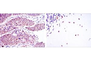 Immunohistochemical analysis of paraffin-embedded ovarian cancer (left) and cerebellum tissues (right) using MSI2 mouse mAb with DAB staining. (MSI2 anticorps)