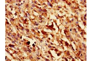 Immunohistochemistry of paraffin-embedded human melanoma using ABIN7153440 at dilution of 1:100 (LGALS1/Galectin 1 anticorps  (AA 2-135))