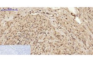 Immunohistochemistry of paraffin-embedded Human uterus cancer tissue using BRCA1 Polyclonal Antibody at dilution of 1:200. (BRCA1 anticorps)