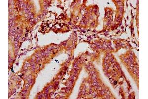 IHC image of ABIN7159553 diluted at 1:400 and staining in paraffin-embedded human endometrial cancer performed on a Leica BondTM system.